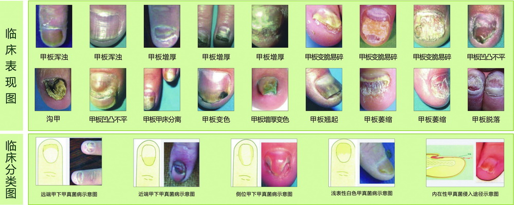 手足病的臨床分類(lèi)