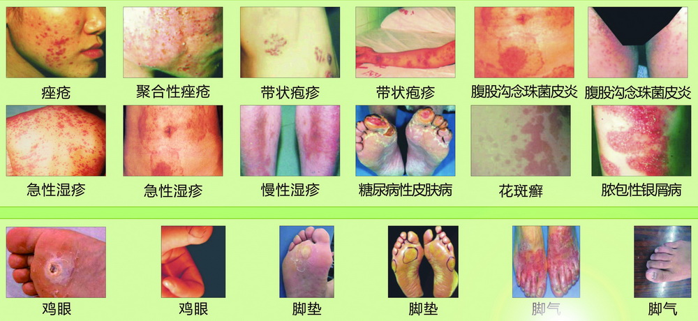 皮膚癬、濕疹、腳氣、腳墊、雞眼